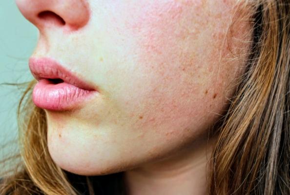 缠绵不肯愈，瘙痒痛难消。 湿疹治疗何去何从？