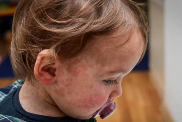 红斑狼疮的根治之路