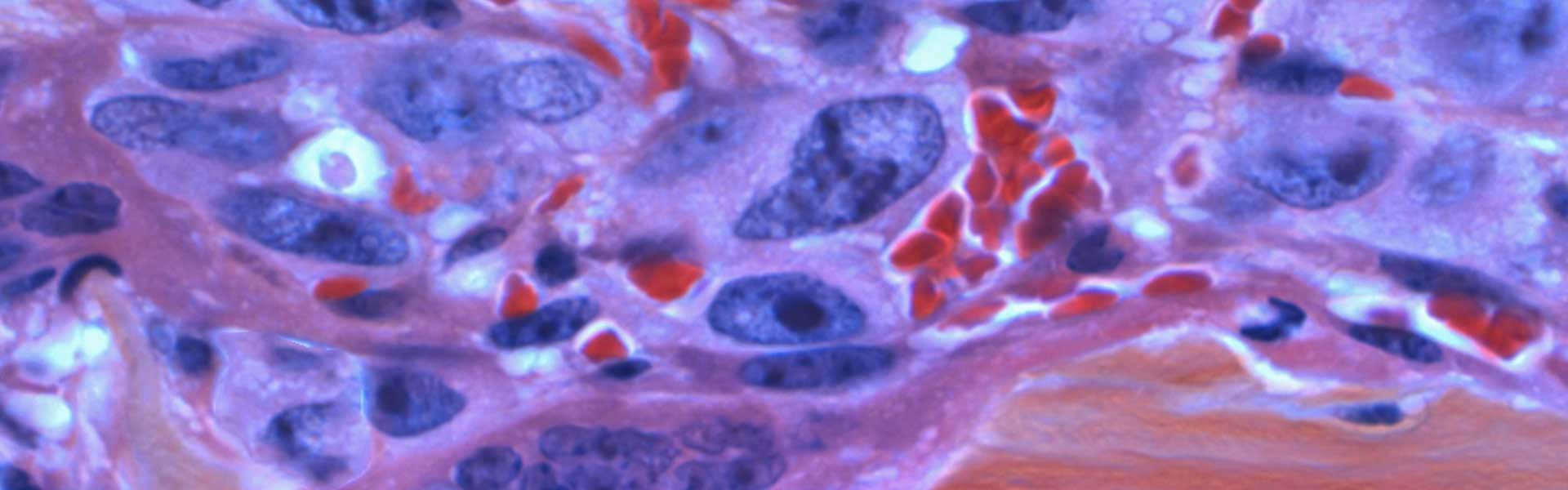 自报告型光动力纳米抗体：大体积肿瘤精准医疗新范式