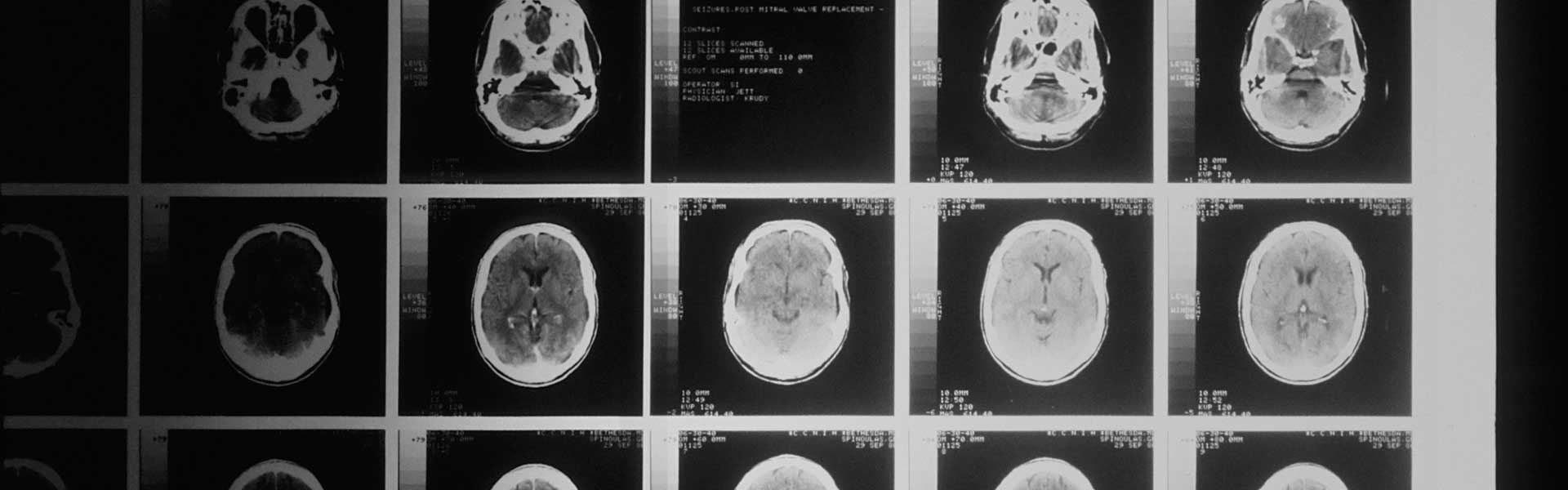 纳米抗体赋能溶瘤病毒：精准猎杀GBM干细胞