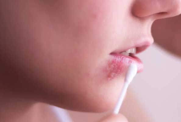 双特异性纳米抗体重塑单纯疱疹病毒治疗格局