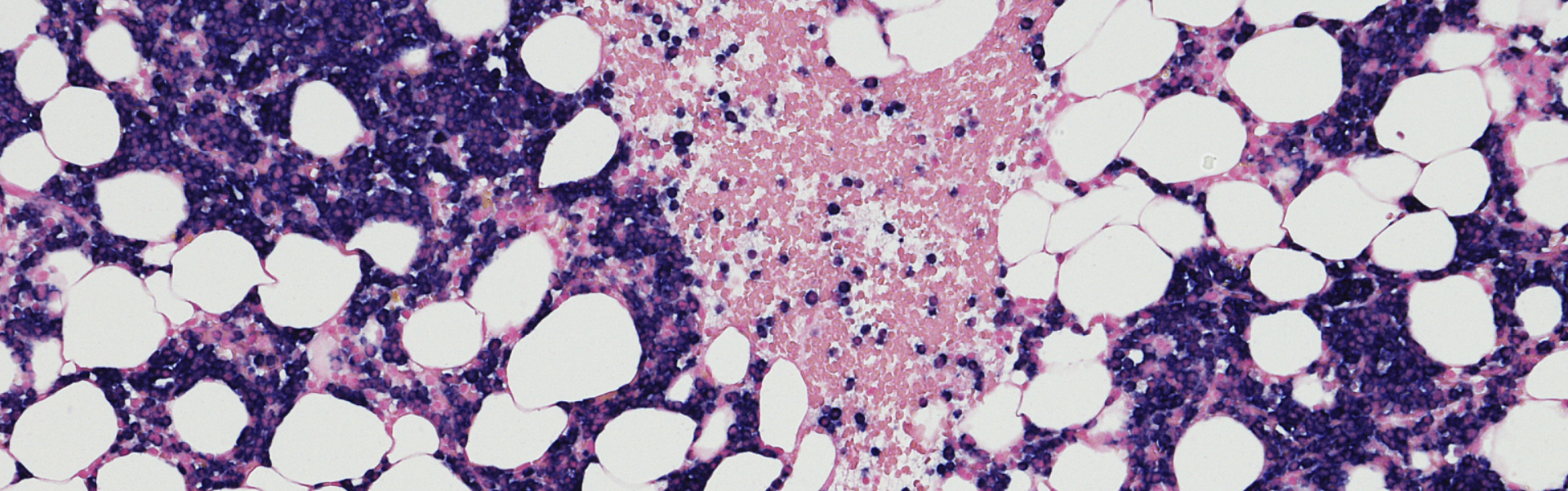 纳米抗体赋能创新药！JSKN016 III期临床首例患者给药