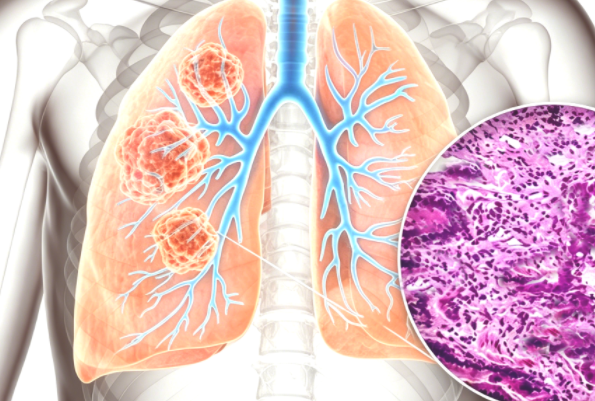 突破 “无药可治” 困境：DLL3 靶点创新疗法与纳米抗体的颠覆价值